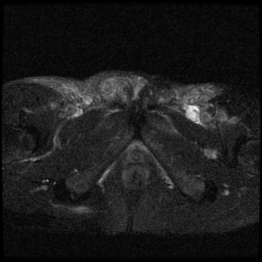 File:Necrotizing epididymo-orchitis with intra-testicular abscess (Radiopaedia 29397-29860 Axial T2 fat sat 7).jpg