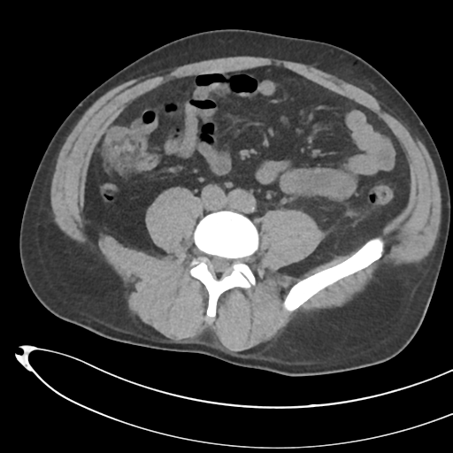 File:Necrotizing pancreatitis with acute necrotic collections (Radiopaedia 38829-41012 Axial non-contrast 51).png