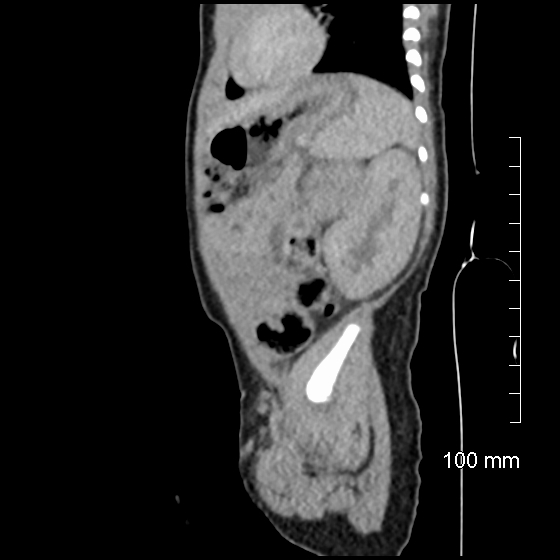 File:Neonatal neuroblastoma (Radiopaedia 56651-63438 C 28).jpg