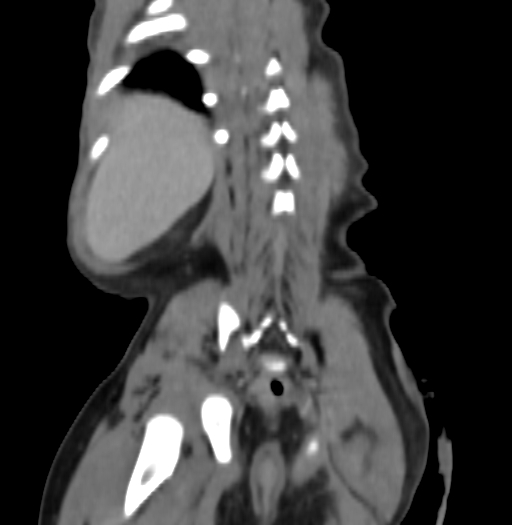 Nephroblastomatosis (Radiopaedia 71294-81607 B 282).jpg