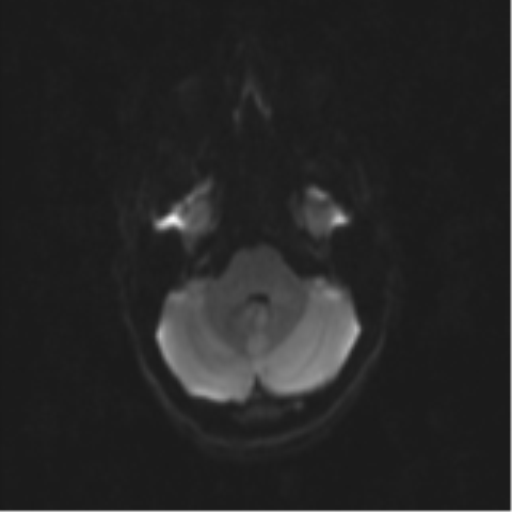 Neurenteric cyst (Radiopaedia 58641-65837 Axial DWI 44).png