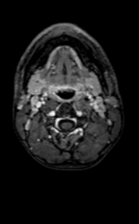 Neuro-Behçet disease (Radiopaedia 90112-107294 Axial T1 C+ 246).jpg