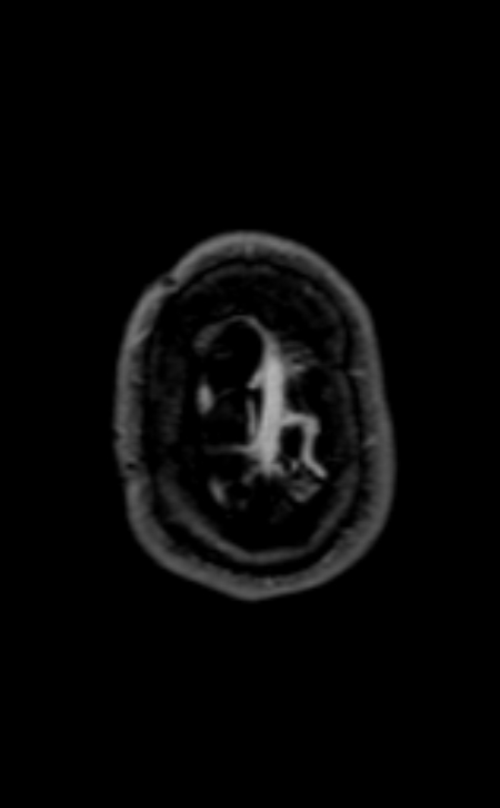 Neuro-Behçet disease (Radiopaedia 90112-107294 Axial T1 C+ 55).jpg