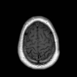 File:Neuro-Behcet's disease (Radiopaedia 21557-21505 Axial T1 C+ 20).jpg