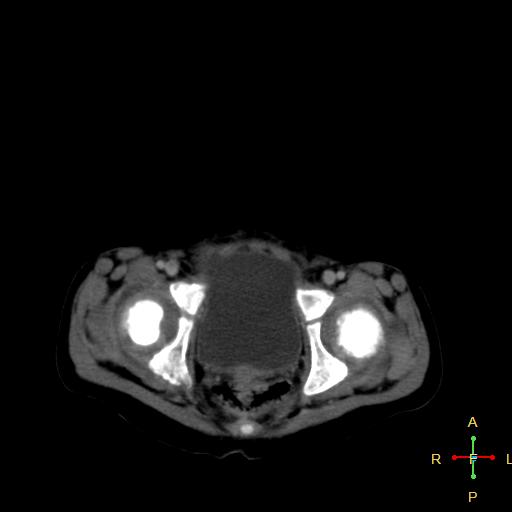 File:Neuroblastoma (Radiopaedia 24751-25016 D 42).jpg