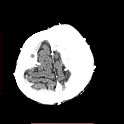 File:Neuroblastoma skull metastasis (Radiopaedia 56053-62683 Axial +Contrast 15).jpg