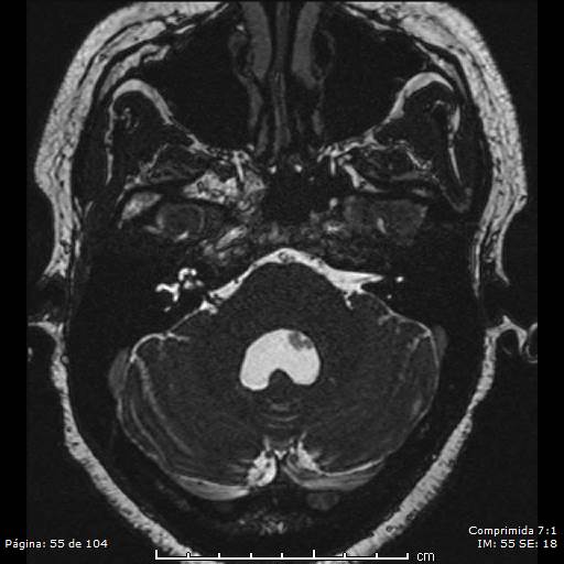 Neurocysticercosis (Radiopaedia 58636-65832 I 55).jpg