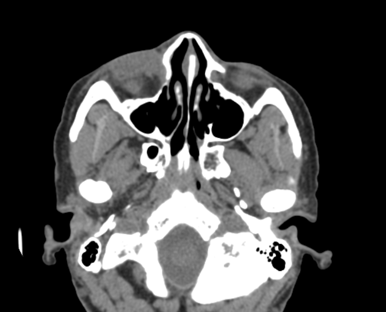 Neurofibromatosis type 1- orbital manifestations (Radiopaedia 49391-54511 Axial non-contrast 34).jpg