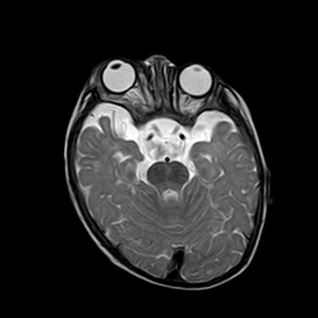 File:Neurofibromatosis type 1 (Radiopaedia 30089-30671 Axial T2 8).jpg