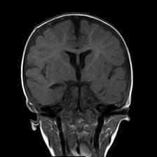 File:Neurofibromatosis type 1 (Radiopaedia 30089-30671 Coronal T1 14).jpg
