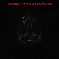 File:Neurofibromatosis type 1 with optic nerve glioma (Radiopaedia 16288-15965 Axial DWI 46).jpg