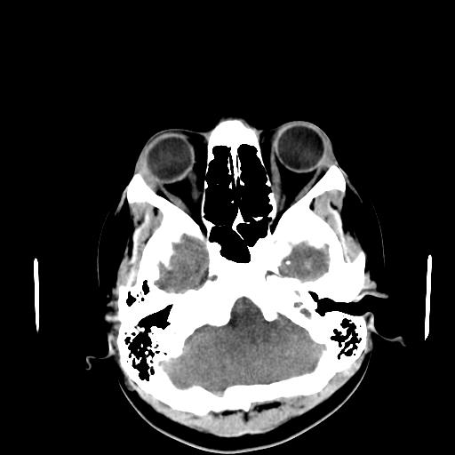 File:Neurofibromatosis type 2 (Radiopaedia 25389-25637 Axial non-contrast 4).jpg