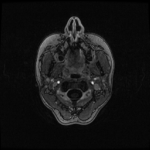 Neurofibromatosis type 2 (Radiopaedia 45229-49244 Axial T1 C+ 12).png