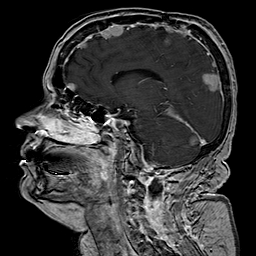 File:Neurofibromatosis type 2 (Radiopaedia 8713-9518 Sagittal T1 C+ 22).jpg