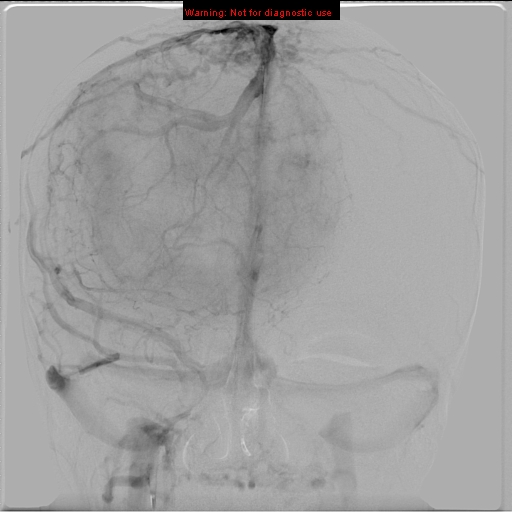 File:Neurofibromatosis type 2 (Radiopaedia 8953-9733 D 24).jpg