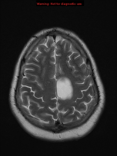 File:Neuroglial cyst (Radiopaedia 10713-11184 Axial T2 5).jpg
