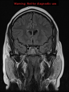 File:Neuroglial cyst (Radiopaedia 10713-11184 Coronal FLAIR 17).jpg