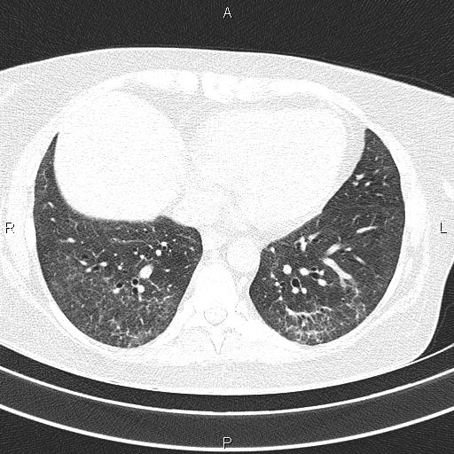 Non-specific interstitial pneumonia (Radiopaedia 83185-97567 Axial lung window 45).jpg