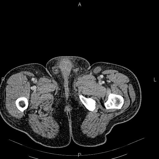 File:Non Hodgkin lymphoma in a patient with ankylosing spondylitis (Radiopaedia 84323-99621 B 71).jpg