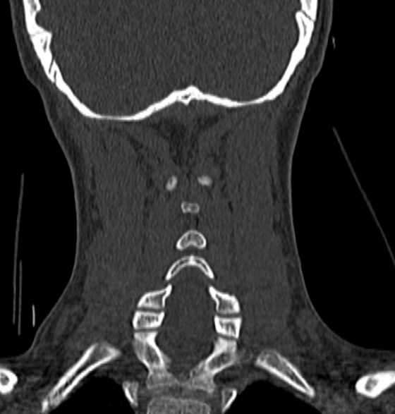 File:Normal CT cervical spine - 12-year-old (Radiopaedia 55352-61775 Coronal bone window 166).jpg