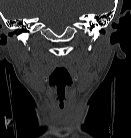 File:Normal CT cervical spine - 12-year-old (Radiopaedia 55352-61775 Coronal bone window 28).jpg
