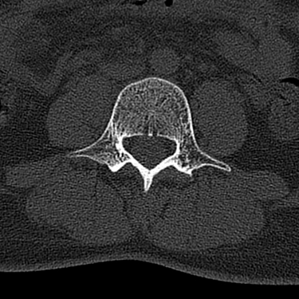 File:Normal CT lumbar spine (Radiopaedia 53981-60118 Axial bone window 46).jpg