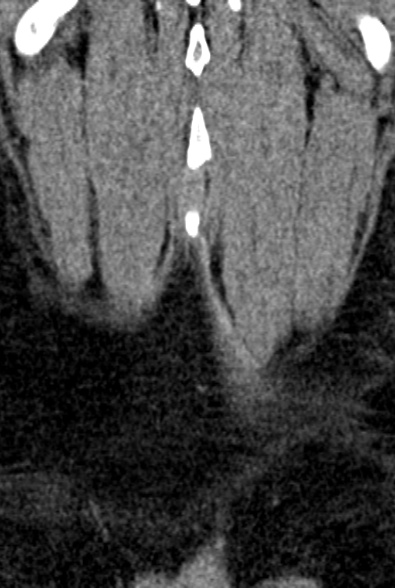 Normal CT lumbar spine (Radiopaedia 53981-60118 F 100).jpg