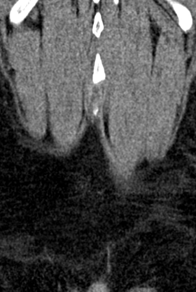 Normal CT lumbar spine (Radiopaedia 53981-60118 F 101).jpg