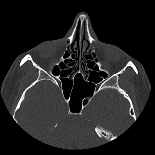 Normal CT paranasal sinuses (Radiopaedia 42286-45390 Axial bone window 55).jpg