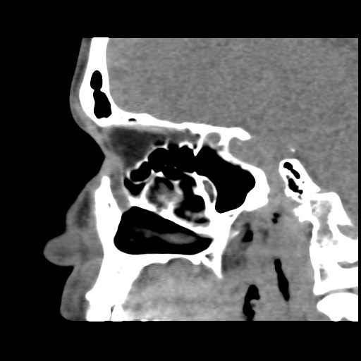 Normal CT paranasal sinuses (Radiopaedia 42286-45390 F 63).jpg