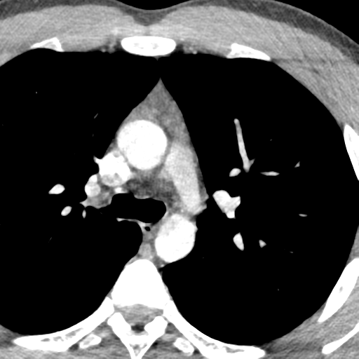 File:Normal CT pulmonary veins (pre RF ablation) (Radiopaedia 41748-44702 A 39).png