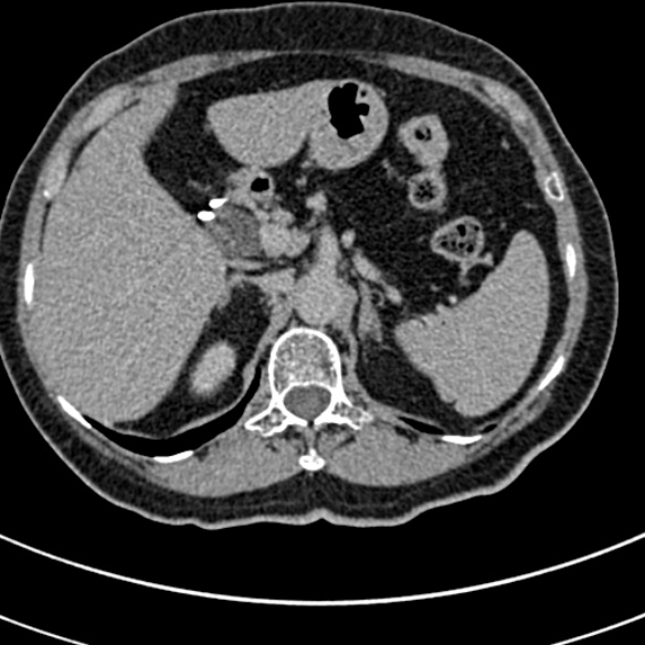 File:Normal CT split bolus study of the renal tract (Radiopaedia 48631-53634 Axial split bolus 22).jpg