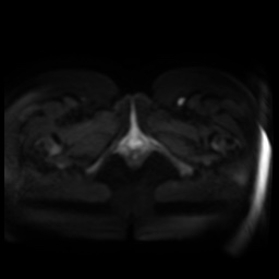 Normal MRI abdomen in pregnancy (Radiopaedia 88005-104548 Axial DWI 39).jpg