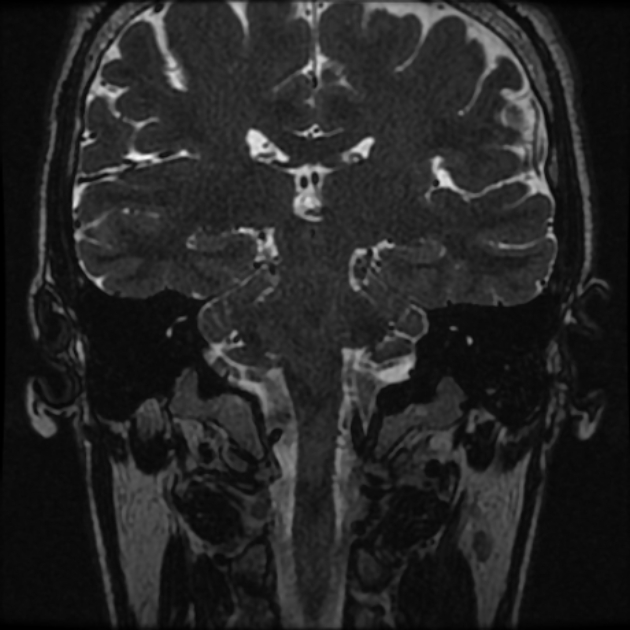 Normal MRI petrous (Radiopaedia 91317-108949 Coronal T2 65).jpg
