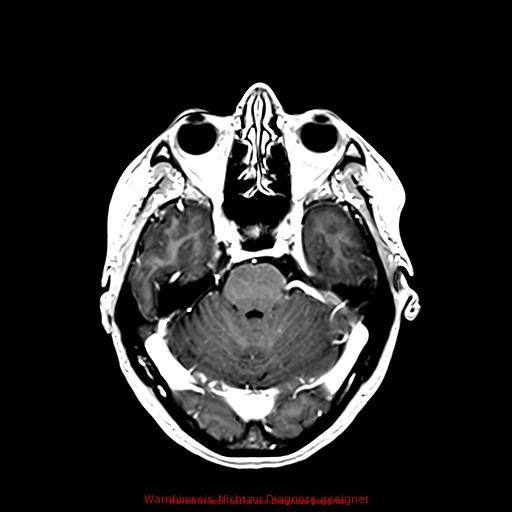 Normal adult brain MRI (non-enhanced and contrast-enhanced) (Radiopaedia 75262-86379 Axial T1 C+ 78).jpg