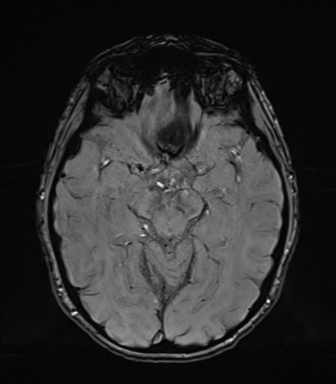 Normal brain MRI (TLE protocol) (Radiopaedia 40748-43405 Axial SWI 36).png