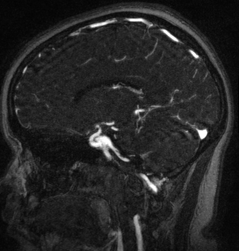 Normal brain MRI and venogram (Radiopaedia 39554-41862 Sagittal MRV 28).jpg