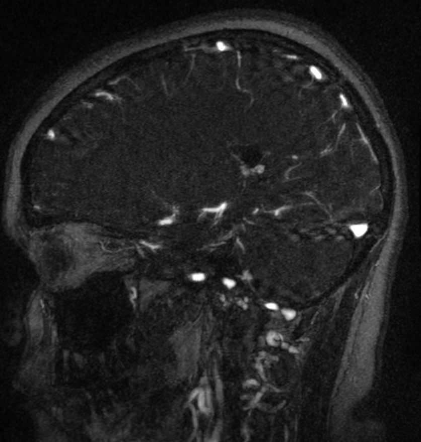 Normal brain MRI and venogram (Radiopaedia 39554-41862 Sagittal MRV 43).jpg