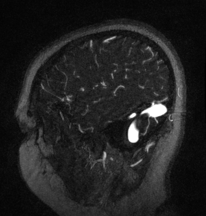 Normal brain MRI and venogram (Radiopaedia 39554-41862 Sagittal MRV 56).jpg