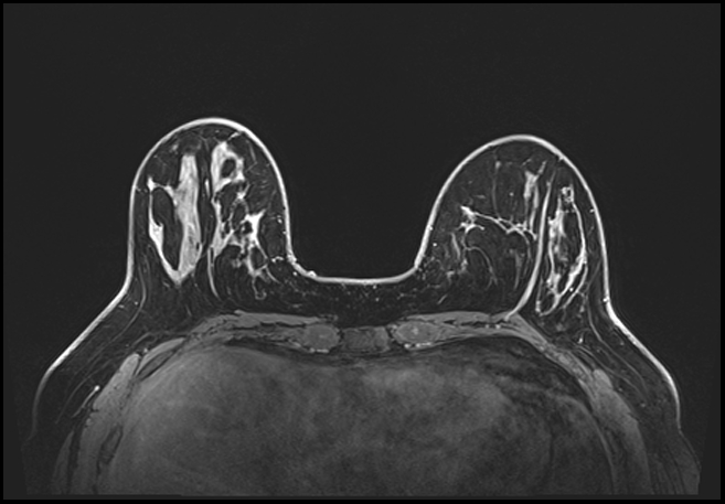 Normal breast MRI - dense breasts (Radiopaedia 80454-93850 C 68).jpg
