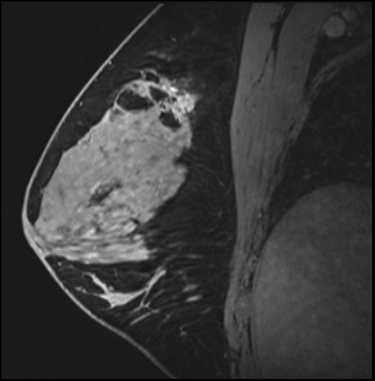 Normal breast MRI - dense breasts (Radiopaedia 80454-93850 I 94).jpg