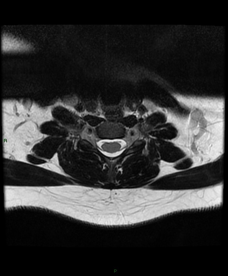 Normal cervical spine MRI (Radiopaedia 80146-93454 Axial T2 70).jpg