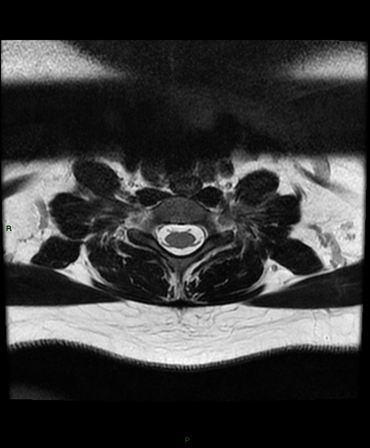 Normal cervical spine MRI (Radiopaedia 80146-93454 Axial T2 82).jpg