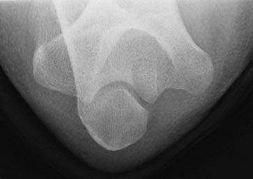 File:Normal elbow (AP acute flexion view) (Radiopaedia 73474-84239 B 1).jpg