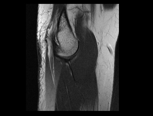 File:Normal elbow arthrograms (Radiopaedia 75550-86805 Sagittal PD 30).jpg
