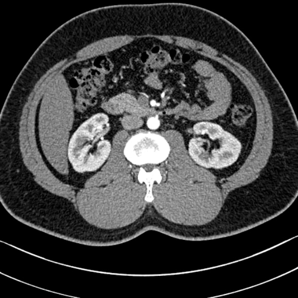 Normal kidneys on 4-phase CT study (Radiopaedia 25889-26038 B 46).jpg
