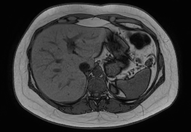 File:Normal liver MRI with Gadolinium (Radiopaedia 58913-66163 B 23).jpg