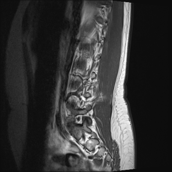 File:Normal lumbar spine MRI- 3 T (Radiopaedia 53280-59250 Sagittal T1 6).jpg