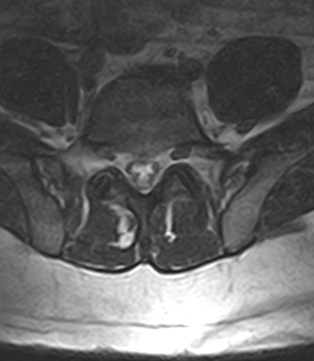 Normal lumbar spine MRI - low-field MRI scanner (Radiopaedia 40976-43699 Axial T2 83).jpg