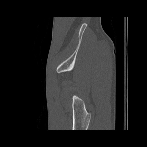 Normal pelvis (Radiopaedia 51473-57238 Sagittal bone window 126).jpg